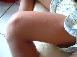 ¿Por qué pican las lesiones de los mosquitos?