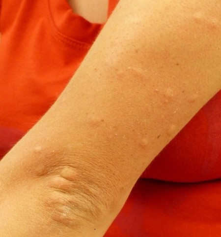 ¿Por qué los mosquitos pican más a unos que a otros?
