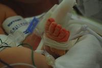 Operan por primera vez a un bebé prematuro de 1,5 kilos de una enfermedad congénita del corazón 