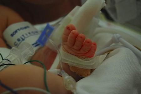 Operan por primera vez a un bebé prematuro de 1,5 kilos de una enfermedad congénita del corazón