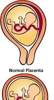 Placenta previa
