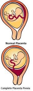 Placenta previa