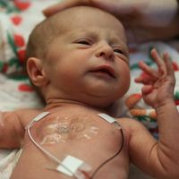 Logran reparar sin cirugía un defecto arterial común en bebés prematuros