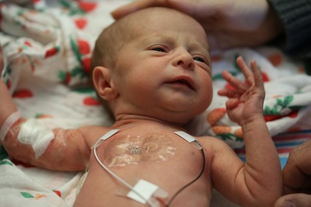 Logran reparar sin cirugía un defecto arterial común en bebés prematuros