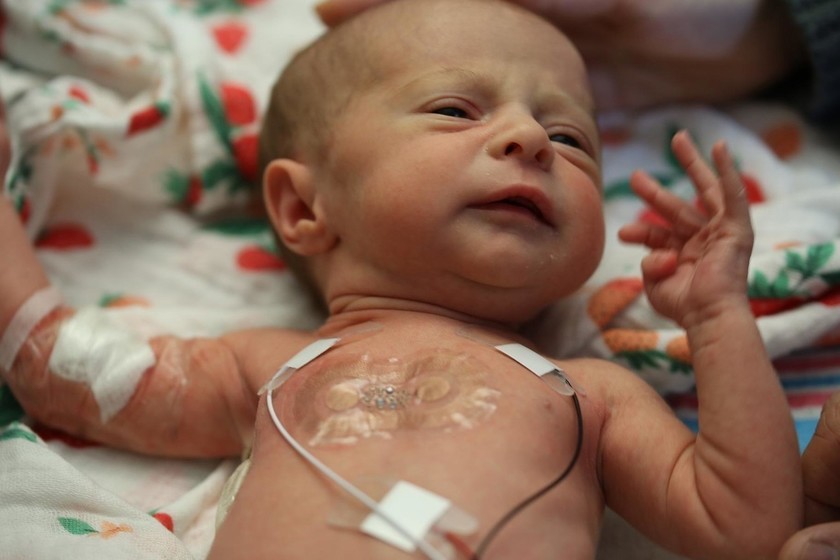 Logran reparar sin cirugía un defecto arterial común en bebés prematuros - Bebés y Más