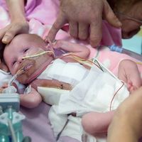 Una bebé que nació con el corazón fuera del cuerpo logra sobrevivir
