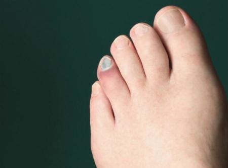 Uñas negras, un problema habitual en los corredores