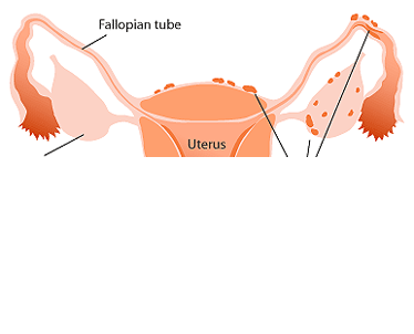 La endometriosis afecta al 15% de mujeres españolas en edad fértil