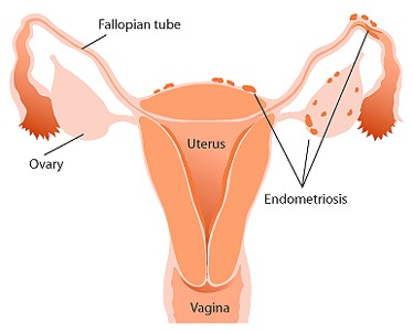La endometriosis afecta al 15% de mujeres españolas en edad fértil