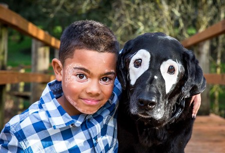 La preciosa historia de un niño con vitiligo y un perro unidos por la misma enfermedad