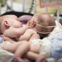 Separan con éxito a dos bebés siamesas de 13 meses unidas por el pecho y el abdomen