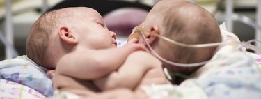 Separan con éxito a dos bebés siamesas de 13 meses unidas por el pecho y el abdomen