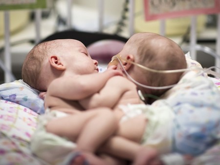 Separan con éxito a dos bebés siamesas de 13 meses unidas por el pecho y el abdomen