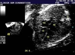Ecocardiografía precoz
