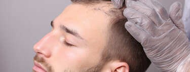 El 50% de los hombres se quedará calvo antes de los 50. Hay una comunidad de Discord buscando una cura clandestina para frenarlo