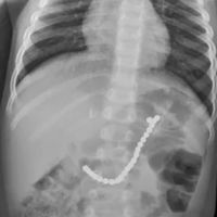 Un niño de dos años ha sido operado de urgencia por tragarse 23 bolas magnéticas: el peligro real de los juegos de imanes