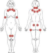Fibromialgia, ¿para cuándo una cura?
