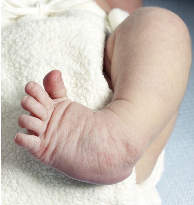 El bebé tiene pie zambo o equino varo en qué consiste esta