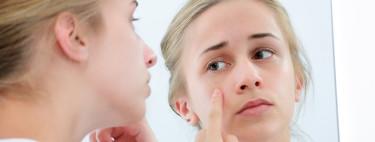 Mi hijo adolescente tiene acné y le afecta psicológicamente: qué hacer para ayudarle