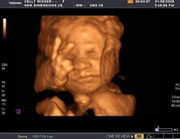 El bebé que "cantó victoria" antes de nacer