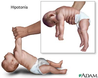 hipotonia