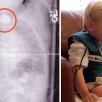 Para que veas lo peligrosas que son las pilas de botón: este bebé estuvo a punto de morir y tiene graves secuelas