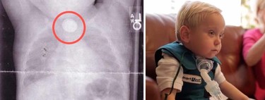 Para que veas lo peligrosas que son las pilas de botón: este bebé estuvo a punto de morir y tiene graves secuelas