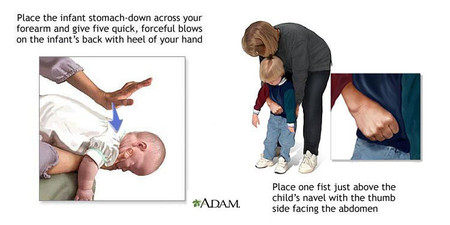 atragantamiento-heimlich