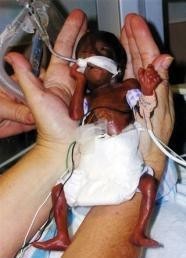 El bebé más pequeño del mundo que nació con 22 semanas de gestación sale adelante