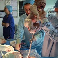 ¿Cuántas cesáreas se practican en España y por Comunidades Autónomas? 