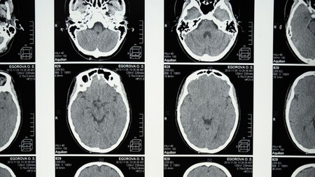 Esta nueva herramienta de inteligencia artificial podría diagnosticar la demencia a partir de un solo escáner cerebral