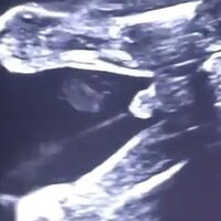 La ecografía de un bebé en el preciso momento en el que hace pis dentro del útero