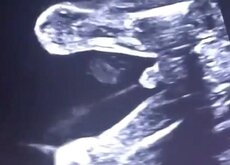 Ecografias En 2d 3d Y 4d