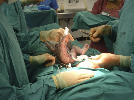 ¿Qué es el prolapso del cordón umbilical?