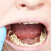 Caries y enfermedad periodontal: la mala salud bucal podría aumentar hasta 86% el riesgo de un derrame cerebral, según la ciencia