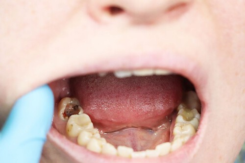 Caries y enfermedad periodontal: la mala salud bucal podría aumentar hasta 86% el riesgo de un derrame cerebral, según la ciencia