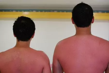 Me he quemado y no quiero pelarme como una gamba... ¿qué hago?