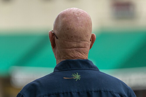 Tratamiento Alopecia Google