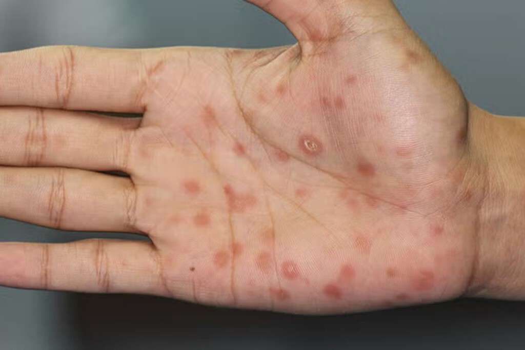 El brote de sífilis en Argentina afecta principalmente a quienes tienen entre 15 y 39 años: cómo prevenir, cuáles son los síntomas y cómo se trata 