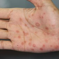 El brote de sífilis en Argentina afecta principalmente a quienes tienen entre 15 y 39 años: cómo prevenir, cuáles son los síntomas y cómo se trata 