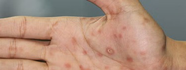 El brote de sífilis en Argentina afecta principalmente a quienes tienen entre 15 y 39 años: cómo prevenir, cuáles son los síntomas y cómo se trata 