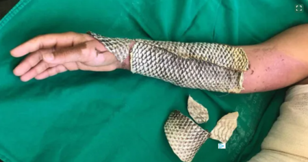 pele de tilápia como curativo