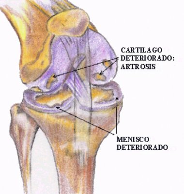 Efecto de los suplementos dietarios en la artrosis de rodilla