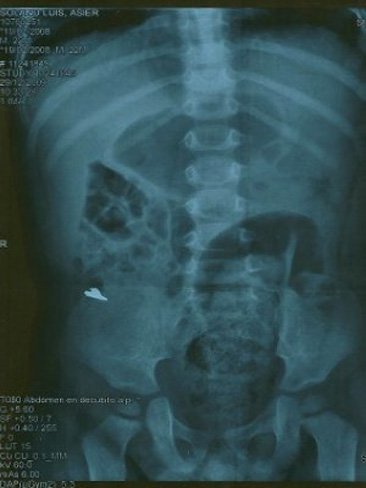 Un bebé se tragó una cuchilla de la batidora con el puré
