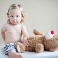 Una niña de 10 años sin vacunar contagia el sarampión a otros cinco menores en Italia y saltan las alarmas 