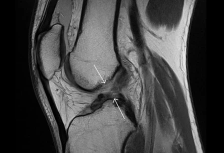Un ligamento completamente artificial es la esperanza para las lesiones del cruzado anterior
