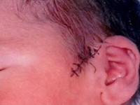 Un bebé sufre un corte al nacer mediante cesárea 
