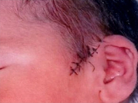 Un bebé sufre un corte al nacer mediante cesárea