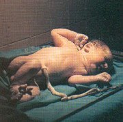 El cuidado del cordón umbilical
