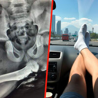 Esta radiografía demuestra lo peligroso que puede ser viajar con los pies encima del tablero, aunque vayas lento